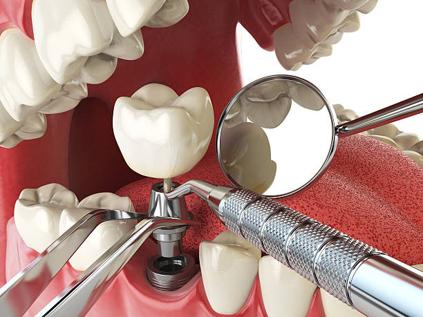 Best Emergency Tooth Extraction in Albion, NY