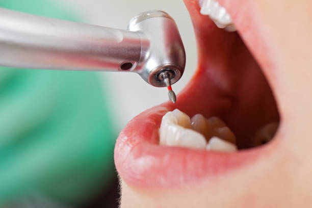 Best Urgent Care for Lost Fillings or Crowns in Albion, NY